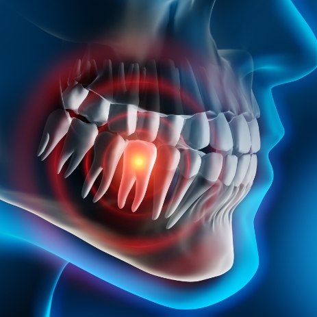 Animated smile with highlighted injured tooth