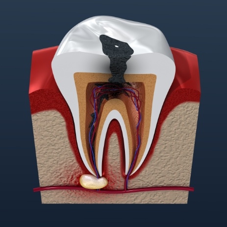 Animated tooth with advanced decay before endodontic retreatment