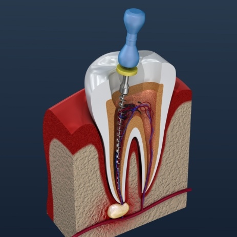 Animated tooth during apicoectomy treatment