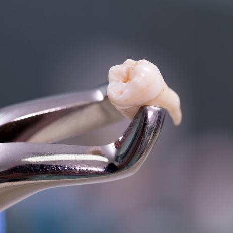 Extracted tooth prior to treatment and intentional replantation