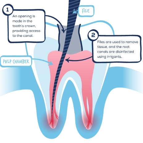 Animated tooth receiving root canal using the Gentel Wave system