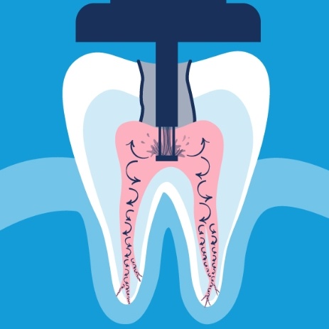 Animated tooth during Gentle Wave treatment