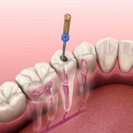 Animated smile during root canal therapy procedure