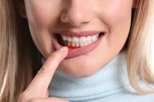 a closeup of a patient inspecting a bump on their gums